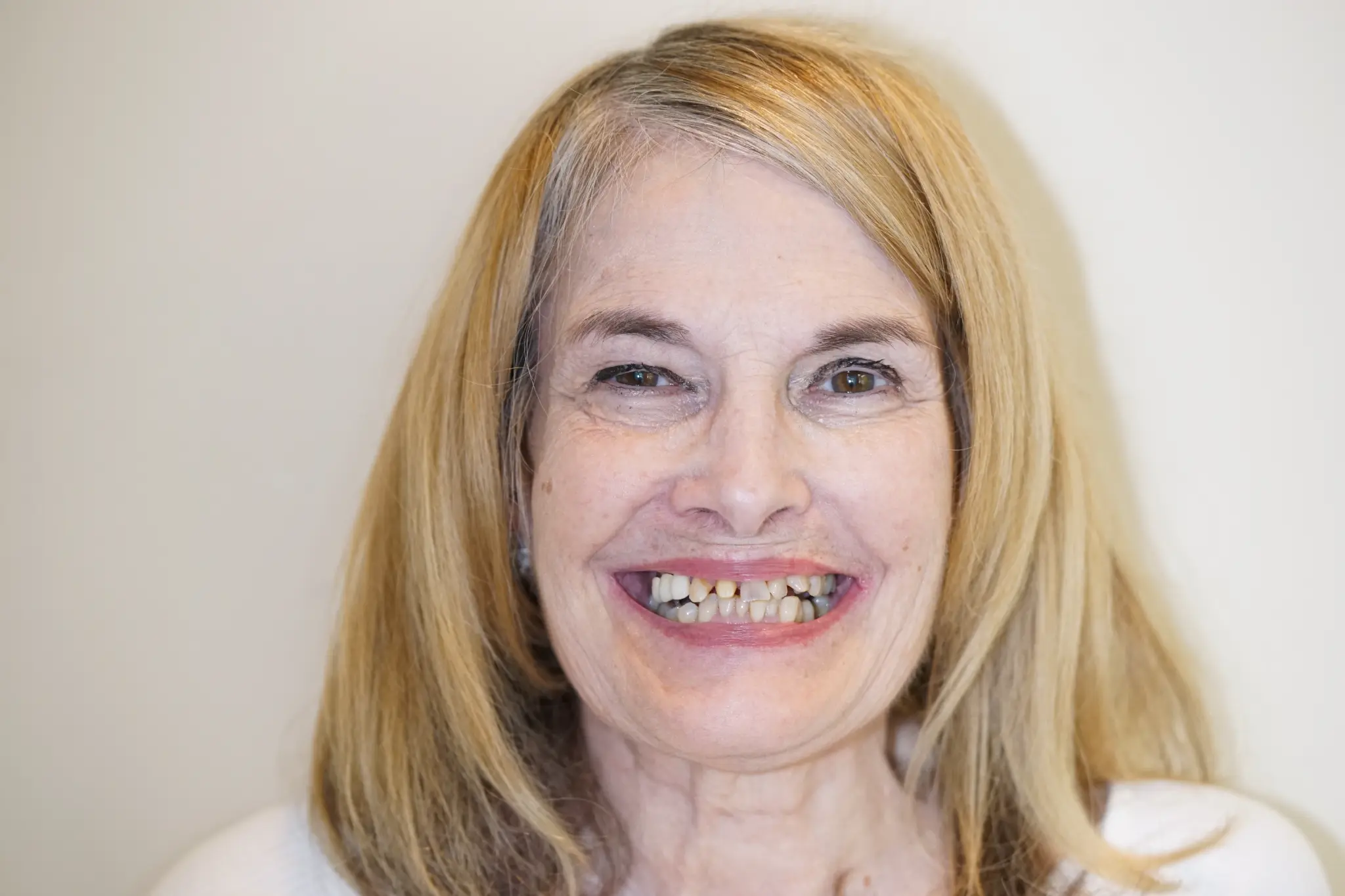 Before All-on-X treatment - multiple missing teeth